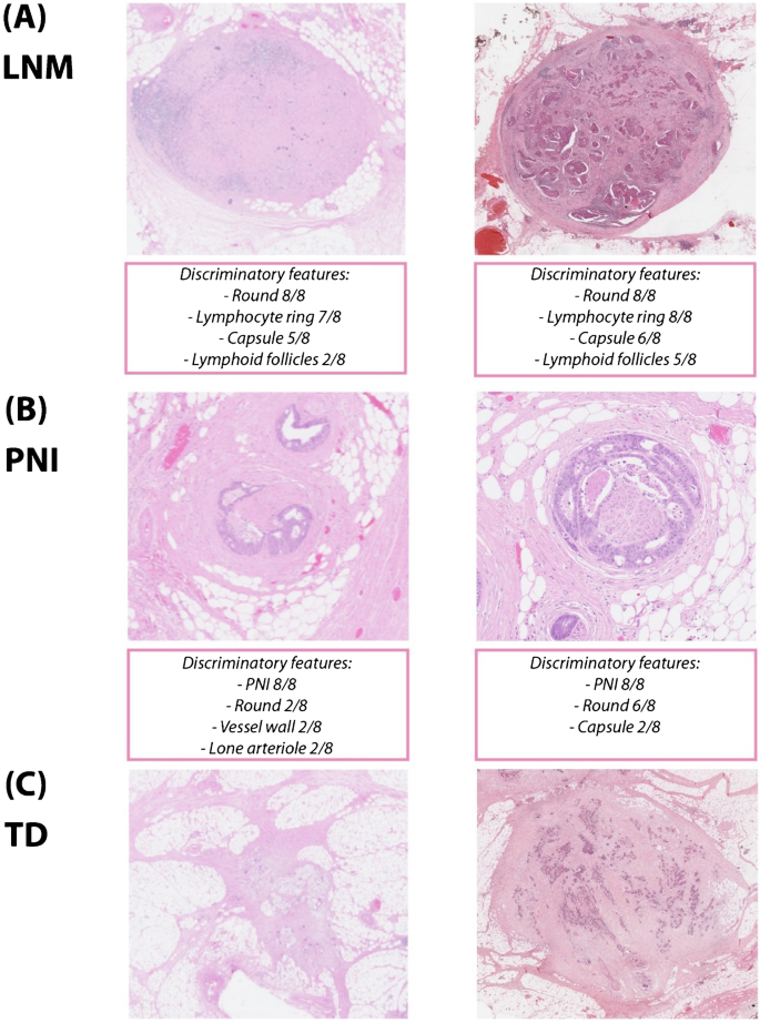 Interobserver variation in the classification of tumor deposits in rectal  cancer—is the use of histopathological characteristics the way to go? |  SpringerLink