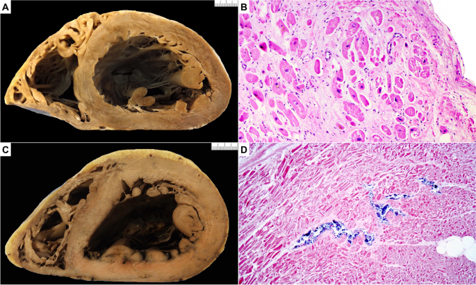 restrictive cardiomyopathy histology