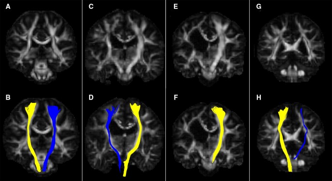 cerebral palsy brain scan comparison