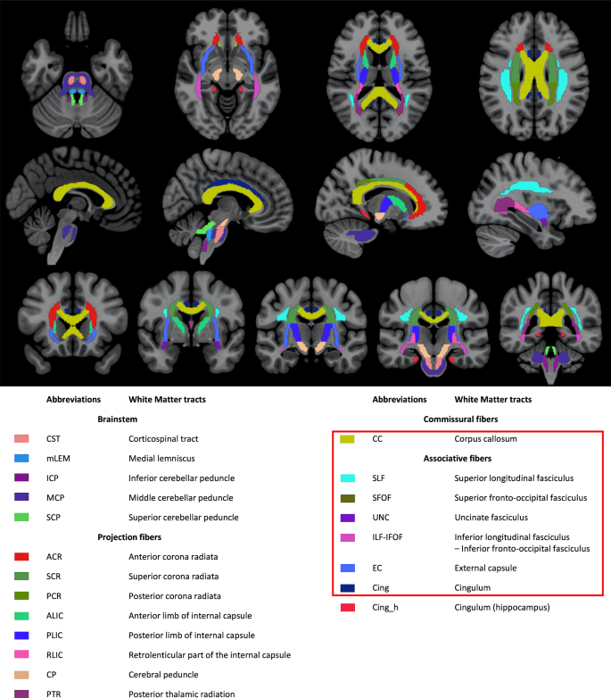 Functional and structural brain connectivity in disorders of ...
