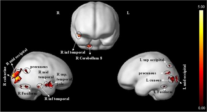 Neural correlates of auditory comprehension and integration of sanskrit ...