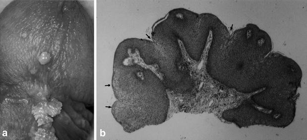 condylomata acuminata und hpv assoziierte krankheitsbilder