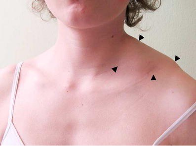 A Left Sided Asymptomatic Supraclavicular Cystic M In 14 Year Old Springerlink A Left Sided Asymptomatic
