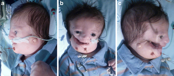 Treacher Collins Syndrome Clinical Implications For The Paediatrician A New Mutation In A Severely Affected Newborn And Comparison With Three Further Patients With The Same Mutation And Review Of The Literature Springerlink