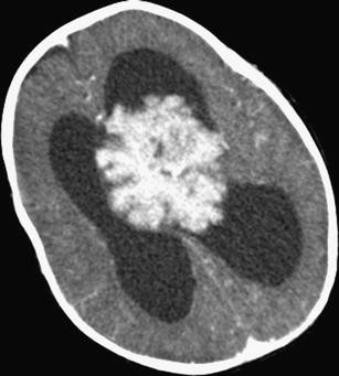 Az agy és a gerincvelő tumorainak osztályozása, Jóindulatú choroid plexus papilloma