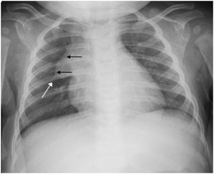 Images in pediatrics: The thymic sail sign and thymic wave 