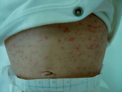 Maculopapular rash in the convalescent phase of Kawasaki disease: case  series and literature review | SpringerLink