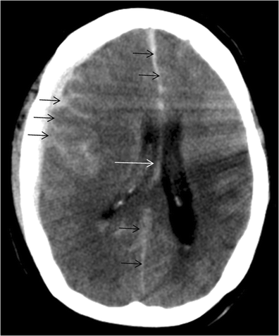 Microcephalic Osteodysplastic Primordial Dwarfism Type Ii Mopd Ii With Multiple Vascular Complications Misdiagnosed As Dubowitz Syndrome Springerlink