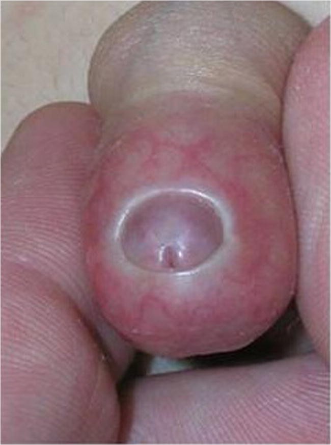 Balanitis xerotica obliterans pictures