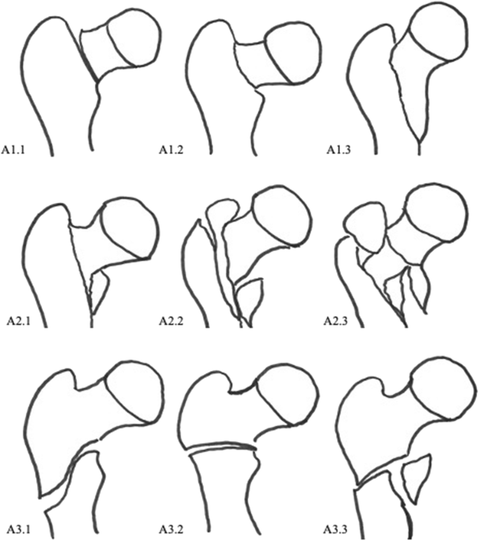 Fractures Of The Trochanteric Region In Children And Young Adolescents A Treatment Algorithm For A Rare Injury Springerlink