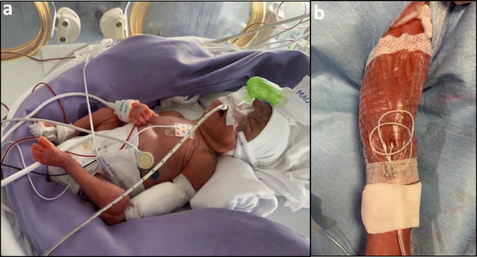How to minimize central lineassociated bloodstream infections in a neonatal  intensive care unit: a quality improvement intervention based on a  retrospective analysis and the adoption of an evidence-based bundle |  European Journal
