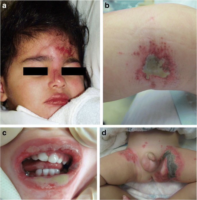 Paediatric chemical burns: a clinical review | SpringerLink
