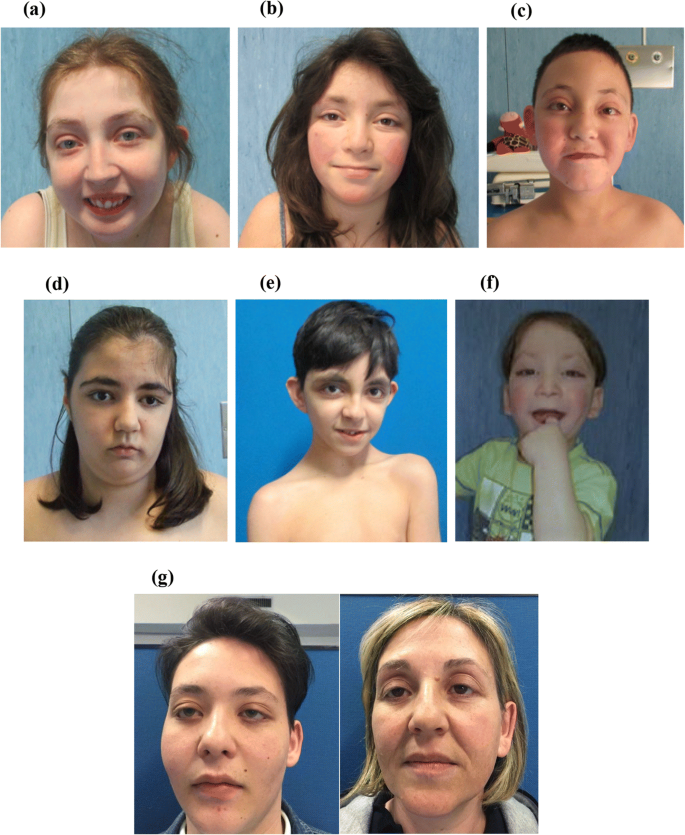 PDF) Oro-dental features as useful diagnostic tool in Rubinstein–Taybi  syndrome
