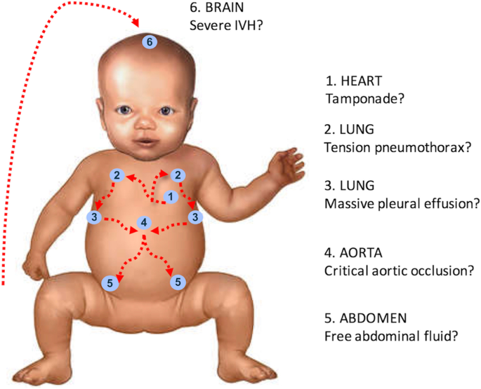 is edwards syndrome fatal
