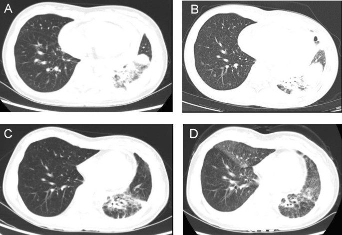 case study of a lung cancer patient figure 1