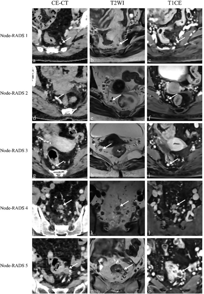 Lymph Rads Diagnostic performance of node-RADS classification for primary lymph ...