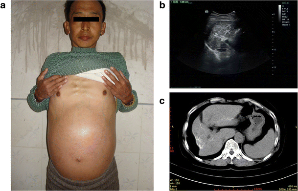 Is schistosomiasis a communicable disease Cancer in peritoneal