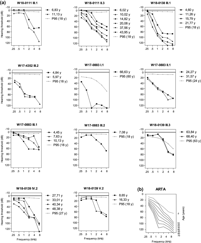 De Novo And Inherited Loss Of Function Variants Of Atp2b2 Are Associated With Rapidly Progressive Hearing Impairment Springerlink