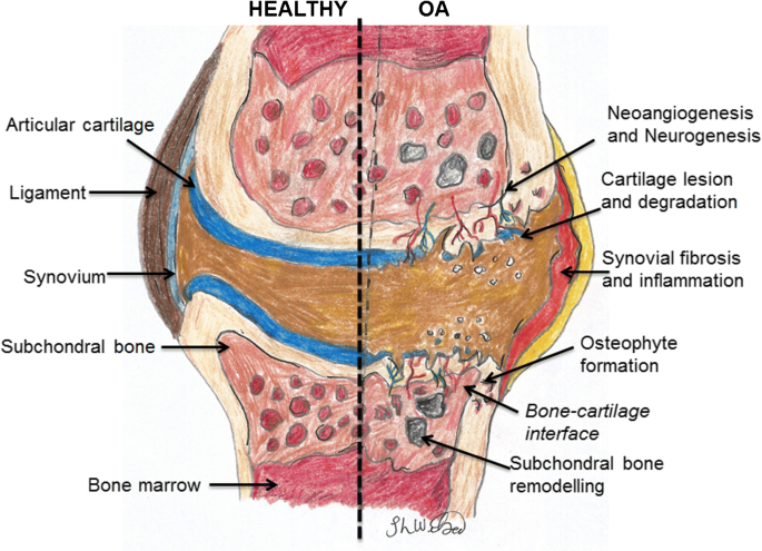 The Use Of Prp Injections In The Management Of Knee Osteoarthritis Springerlink The Use Of Prp Injections In The Management Of Knee Osteoarthritis Springerlink