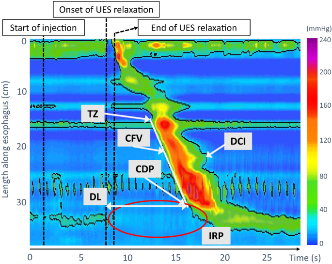 Elicitation Of The Swallowing Reflex By Esophageal Stimulation In Healthy Subjects An Evaluation Using High Resolution Manometry Springerlink Elicitation Of The Swallowing Reflex By Esophageal Stimulation In Healthy Subjects An Evaluation Using High Resolution Manometry Springerlink