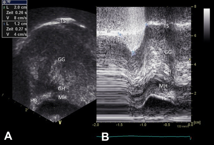 Presbyphagia Diagnostics Using M-Mode Ultrasound: Changes in the Tongue  Movement Pattern | SpringerLink