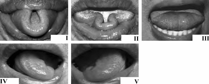 Five Specific Tongue Movements in a Healthy Population | SpringerLink