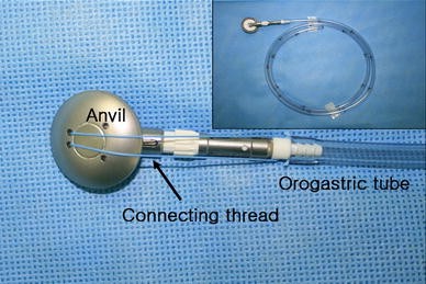 Intracorporeal circular stapling esophagojejunostomy using the transorally  inserted anvil (OrVil™) after laparoscopic total gastrectomy | SpringerLink
