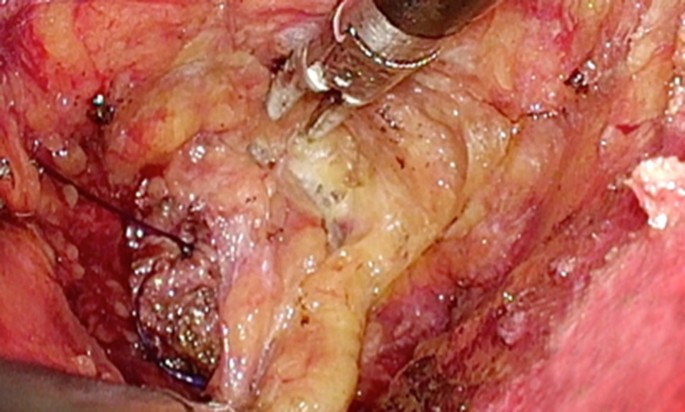 gravid Engager Hævde The current state of the transanal approach to the ileal pouch-anal  anastomosis | SpringerLink