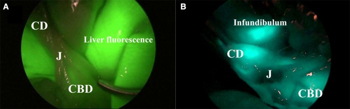 Routine near infra-red indocyanine green fluorescent cholangiography versus intraoperative cholangiography during laparoscopic cholecystectomy: a case-matched comparison | SpringerLink Routine near infra-red indocyanine green fluorescent cholangiography versus intraoperative cholangiography during laparoscopic cholecystectomy: a case-matched comparison | SpringerLink
