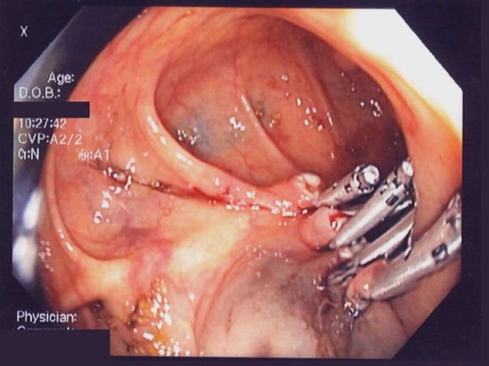 Management Of Colonoscopic Perforation A Systematic Review And Treatment Algorithm Springerlink