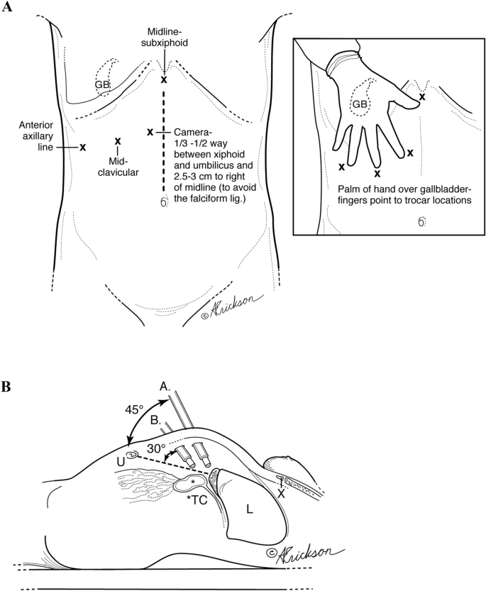 Posterior Infundibular Dissection Safety First In Laparoscopic Cholecystectomy Springerlink