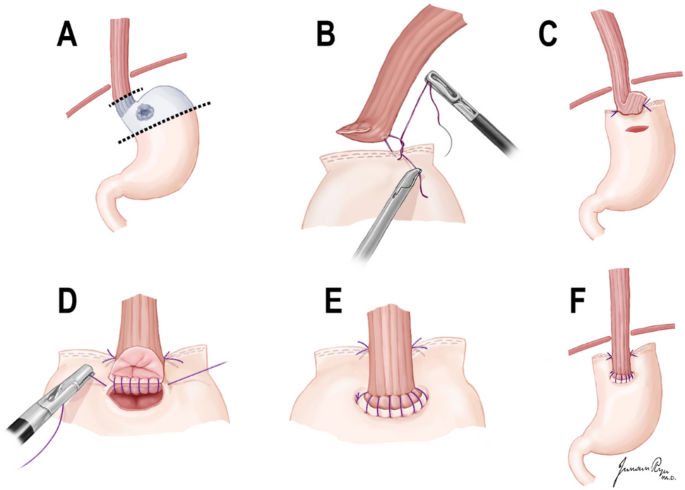 FOSA Surgical Associates - Which would you prefer - Silicone or