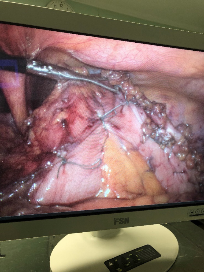 Laparoscopic pictures of the fibrinous adhesion, dark brownish ascetic