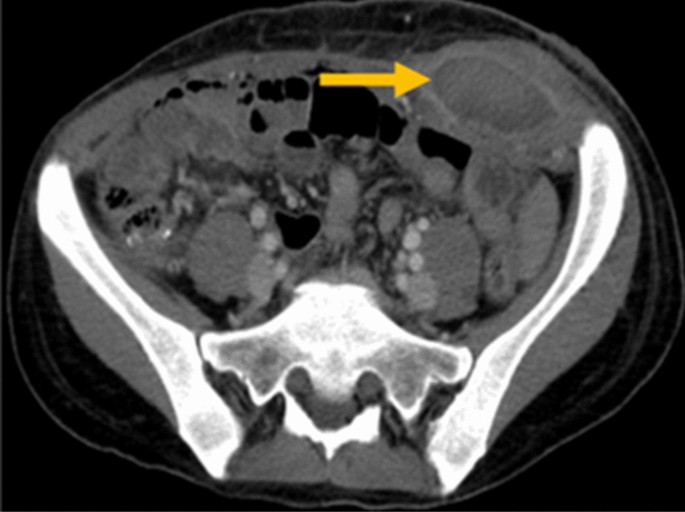 How Abdominoplasty Can Give You a Flat Stomach: Rafael C. Cabrera