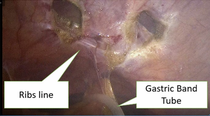 Surgical glue & bathing (added photo of m - Endometriosis UK