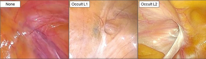 The clinical implications of occult hernia identified during laparoscopic peritoneal dialysis catheter insertion | Surgical Endoscopy |