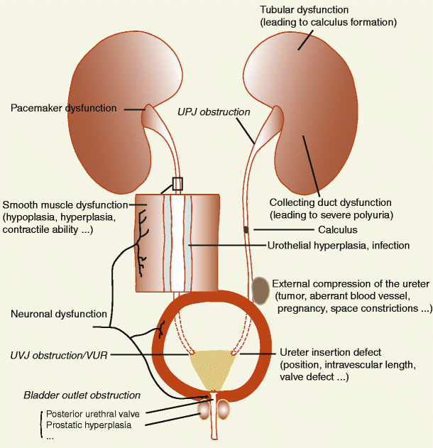 Genetic and developmental basis for urinary tract obstruction | SpringerLink