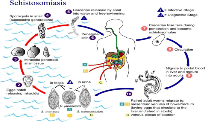 Urinary Schistosomiasis