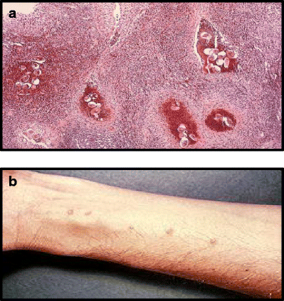 urinary schistosomiasis i