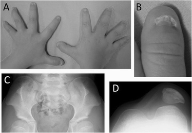 Spectrum of LMX1B mutations: from nail–patella syndrome to isolated  nephropathy | SpringerLink