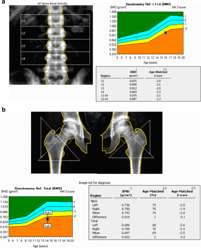 Bone markers in low and high turnover bone disease in CKD