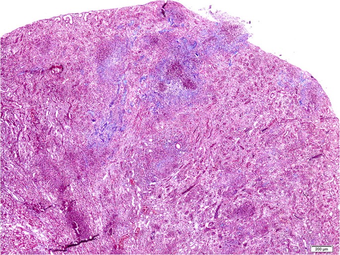 prostatitis férfiakban és jeleiben