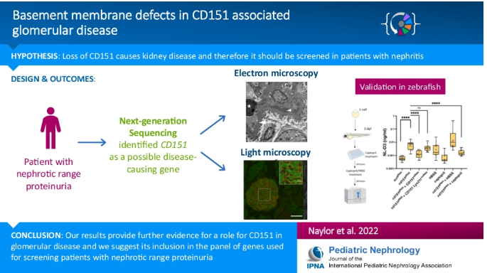Cd151 Associated Glomerular Disease, Basement Membrane Defects In Genetic Kidney Diseases