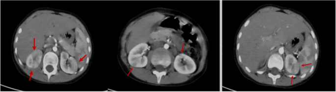 Bilateral Flank Pain