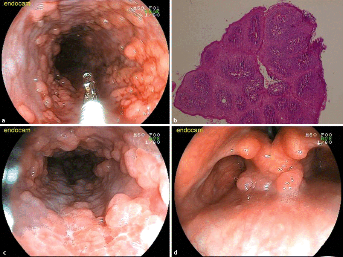 esophageal papillomatosis