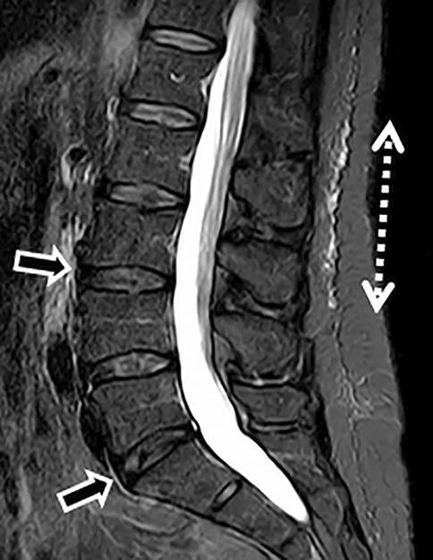 When An Incidental Mri Finding Becomes A Clinical Issue Springerlink