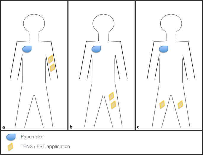 Influence of electrical stimulation therapy on permanent pacemaker function  | SpringerLink