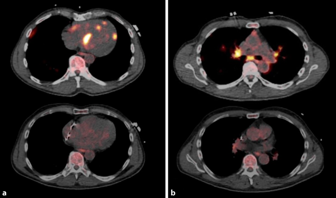 PET-CT in the diagnosis of cardiac and pulmonary sarcoidosis | Wiener  klinische Wochenschrift
