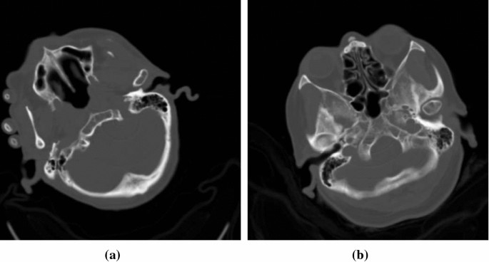 Removing ring artifacts in CBCT images via generative adversarial networks  with unidirectional relative total variation loss | SpringerLink