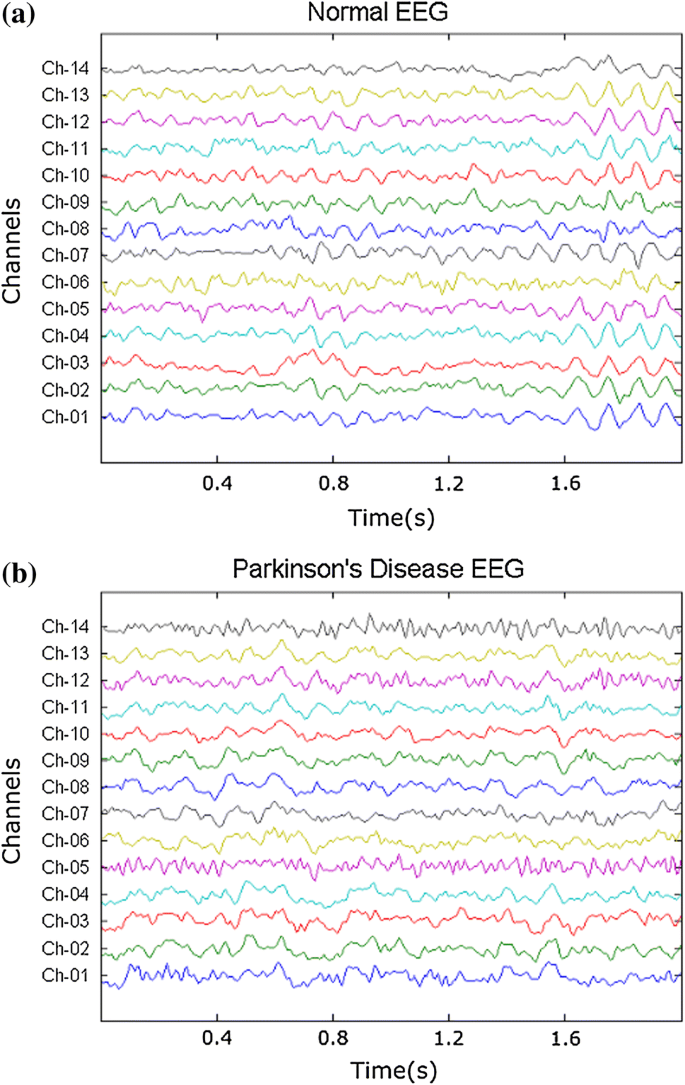 10 conditions diagnosed with an eeg